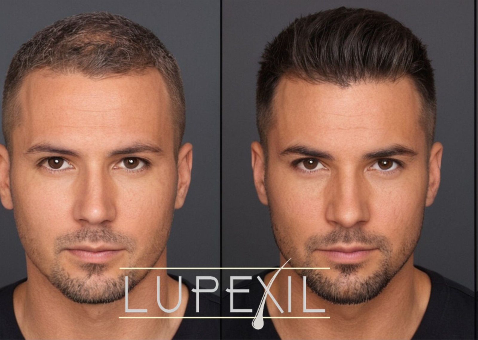 resultados minoxidil cabello
