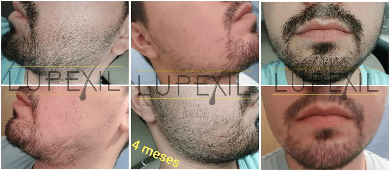 resultados minoxidil lupexil 7